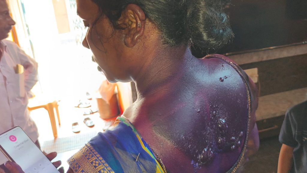राजपत्रिका : सक्ती - घर में अचानक ब्लास्ट हुआ गैस सिलेंडर, आग बुझाने की कोशिश में 9 लोग झुलसे, 6 की हालत नाजुक KSHITITECH