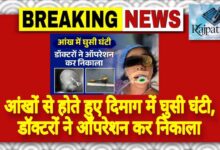 राजपत्रिका : आंखों से होते हुए दिमाग में घुसी घंटी, डॉक्टरों ने ऑपरेशन कर निकाला KSHITITECH
