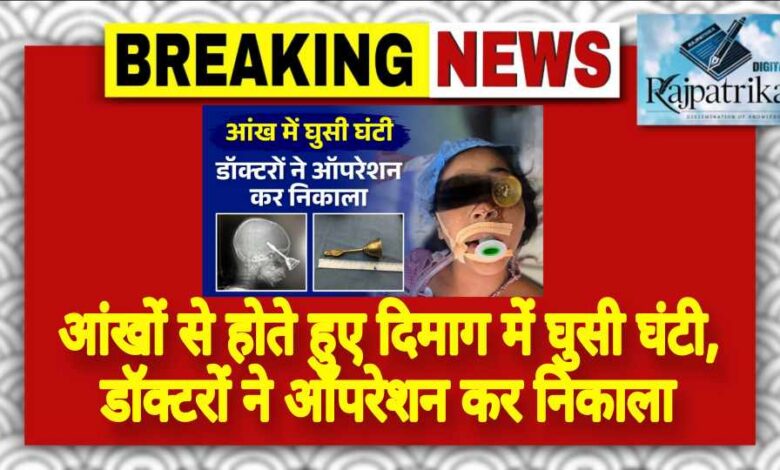 राजपत्रिका : आंखों से होते हुए दिमाग में घुसी घंटी, डॉक्टरों ने ऑपरेशन कर निकाला KSHITITECH